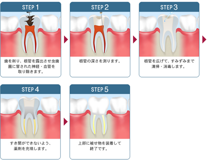 歯の根管治療について