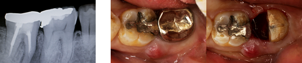 抜歯治療のレントゲン画像